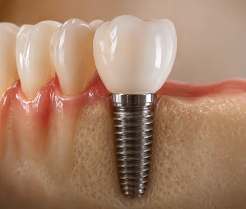 Modelo de implante dentário de titânio com coroa de cerâmica fixado ao osso